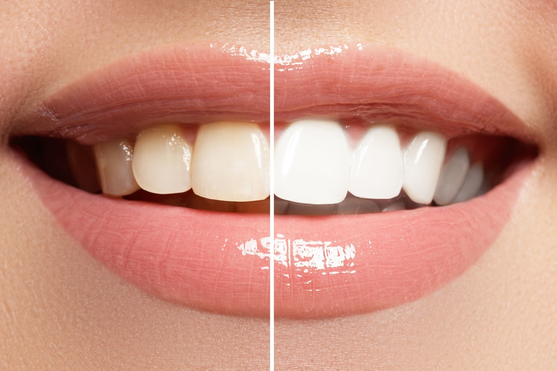 Как сделать зубы очень белыми - виды отбеливания